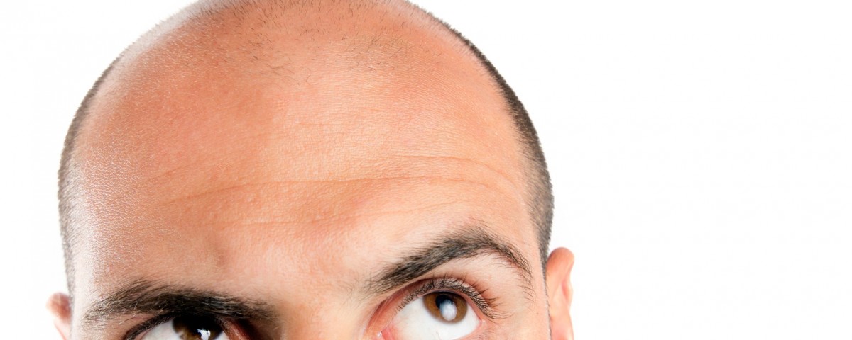 causes of hair loss in men